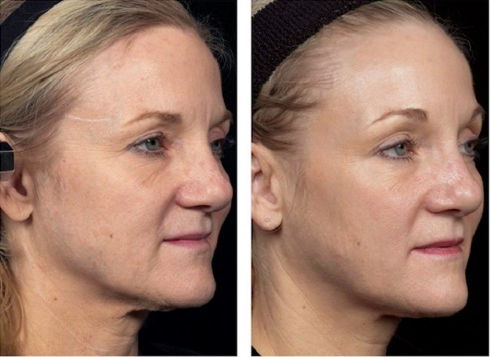 thermage before and after
